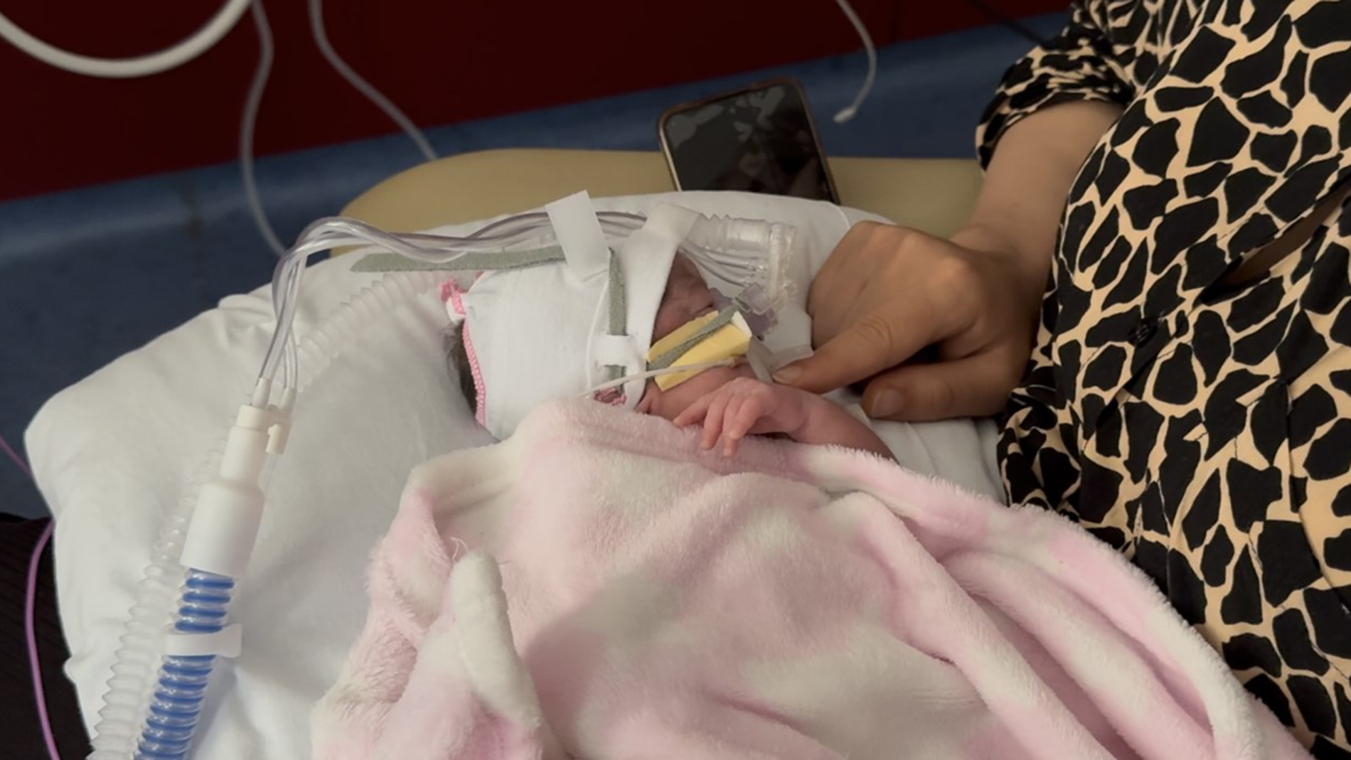 Die derzeit improvisierte Positionierung von Atemschläuchen und Masken bei Neugeborenen – oft mit Schwämmen und provisorischen Stützen, um Hautschäden zu vermeiden – zeigt den dringenden Bedarf an sicheren, personalisierten Lösungen.