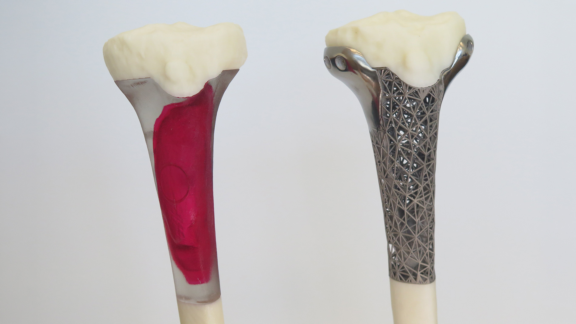 3D-gedrucktes Modell der proximalen Tibia mit dem resezierten Tumorvolumen (links) sowie das tatsächlich gefertigte Titanimplantat, das zur Überprüfung der anatomischen Passgenauigkeit auf das Kunststoff-Knochenmodell aufgesetzt wurde (rechts).