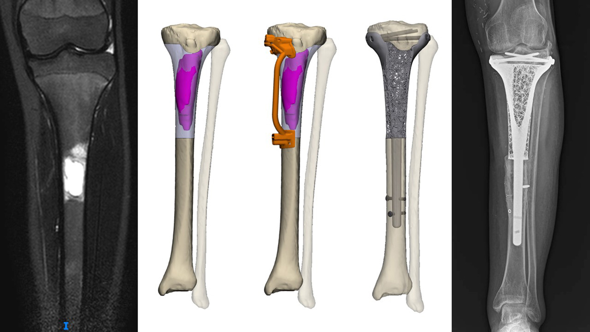 Von links nach rechts: Präoperativer MRT-Scan; CAD-Ansichten des 3D-Knochenmodells mit segmentierten Tumorgrenzen, Positionierung der chirurgischen Schnittschablone und finalem Titanimplantat; sowie postoperatives Röntgenbild, das den vollständigen Erhalt des Gelenks zeigt.