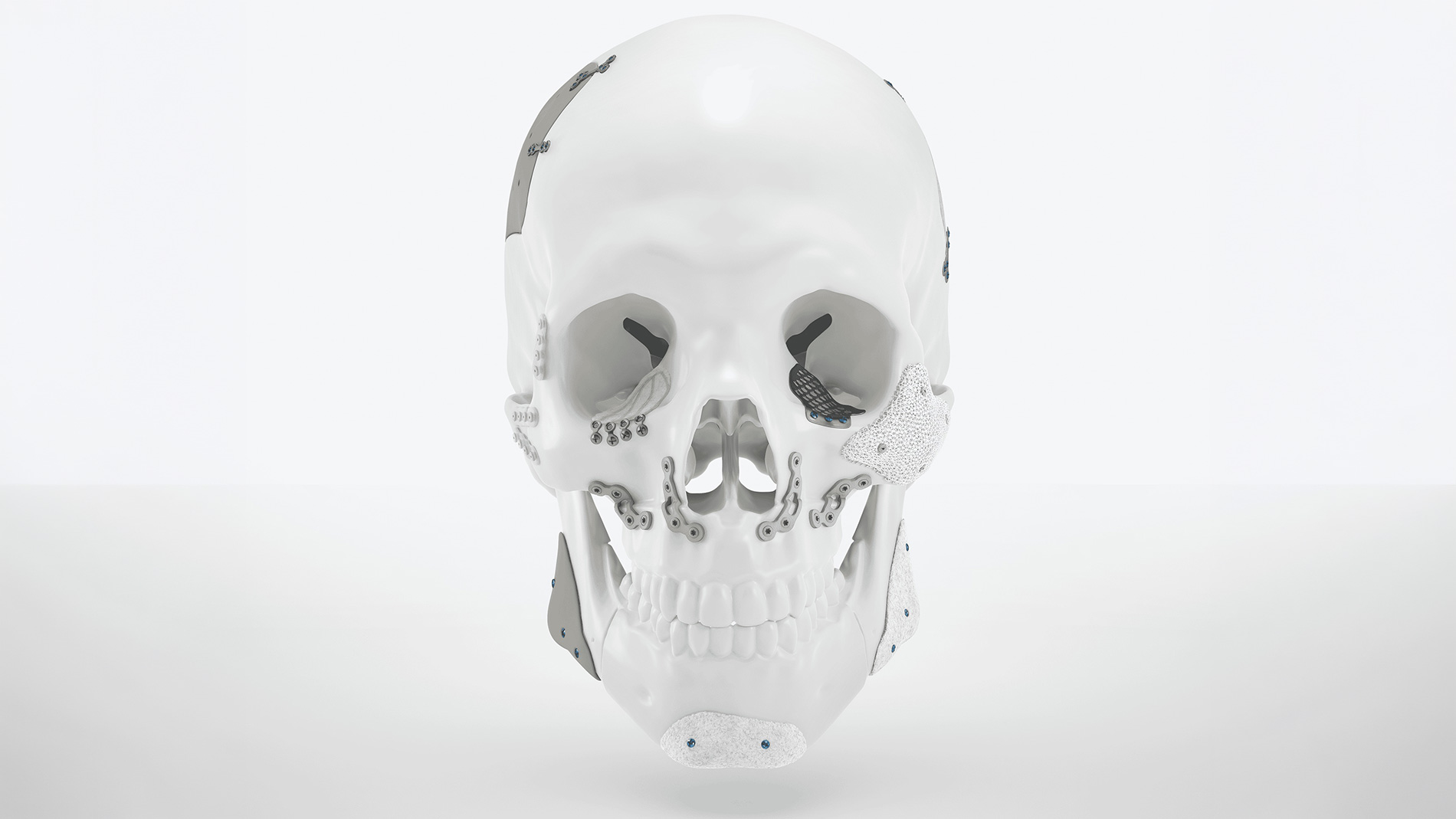 Das kraniomaxillofaziale Portfolio von KLS Martin auf IPS Gate kombiniert patientenspezifische Implantate aus Titan und Biokeramik. Image: Lithoz