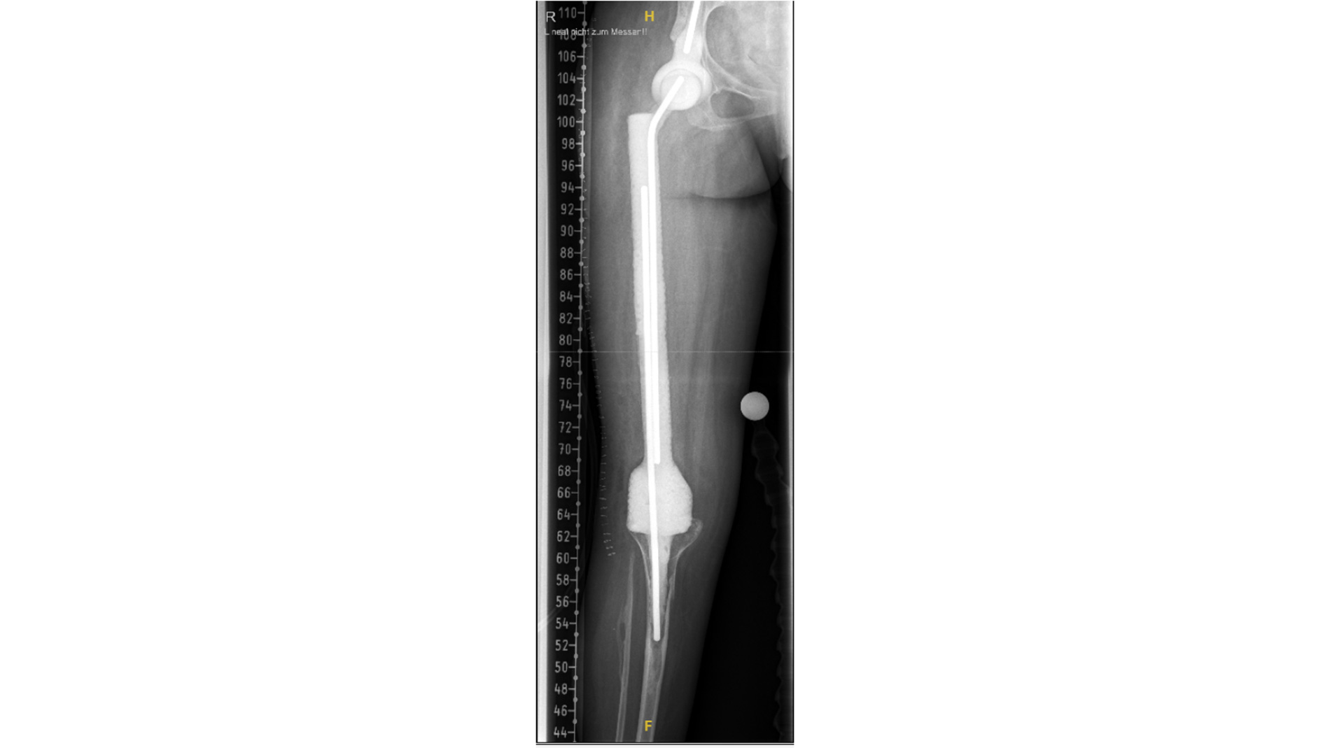 X-ray image of a PMMA joint spacer. Image: UKM