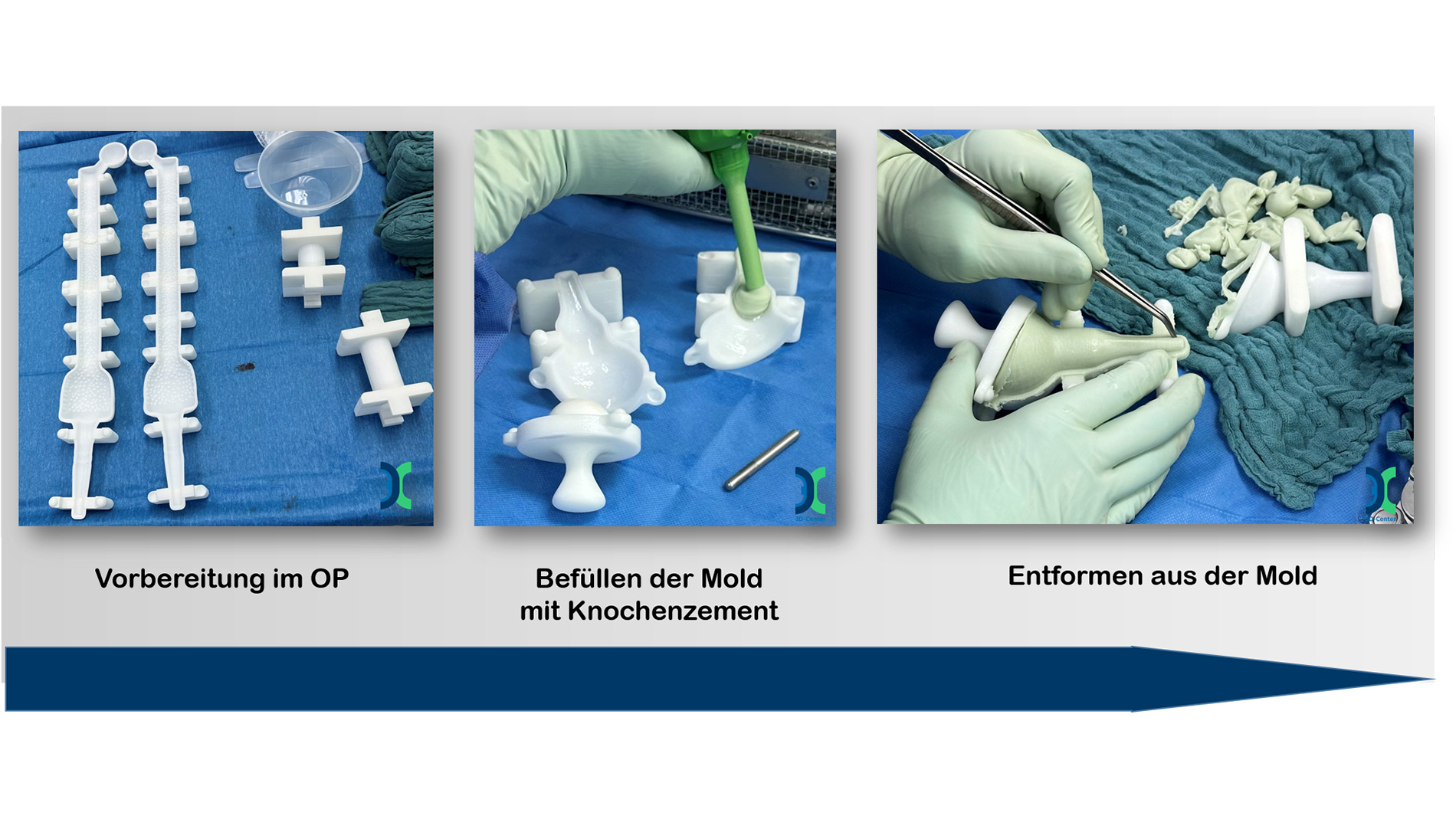 Operating room procedure: A finished, custom PMMA spacer is produced in a matter of minutes using patient-specific, 3D-printed molds. Image: UKM