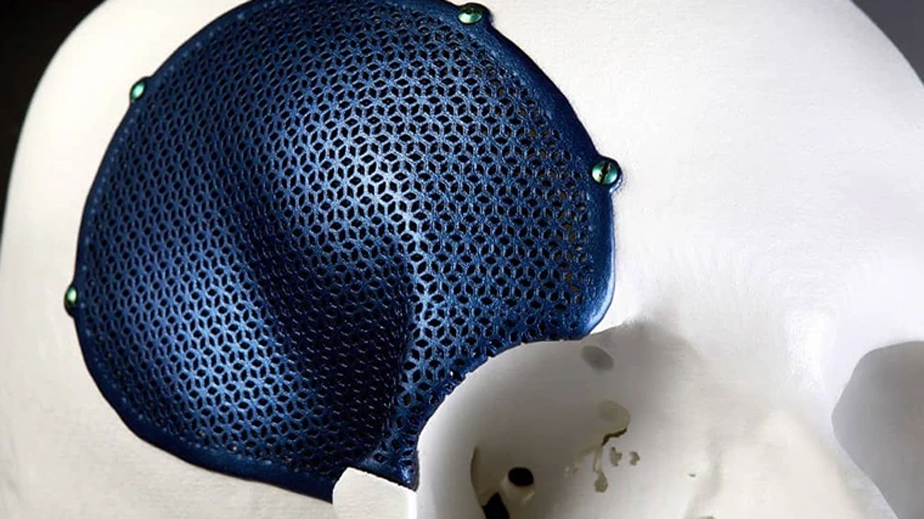 cmf-titanium-implant